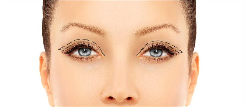 Blefaroplastie